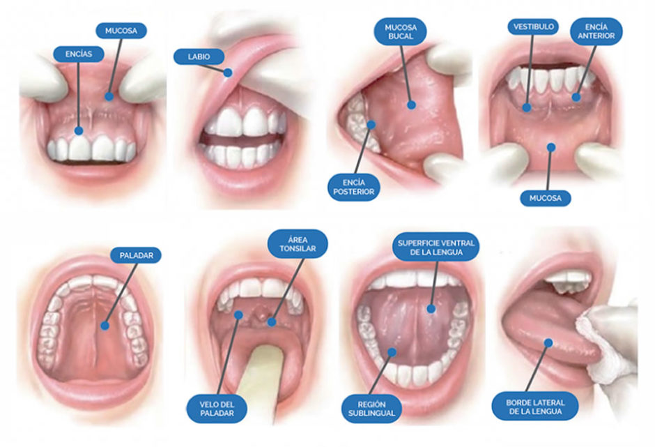 Virus Papiloma Vph Cuidado Dental Personalizado